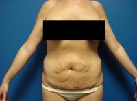 Abdominoplasty