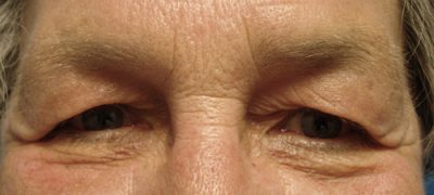 Blepharoplasty