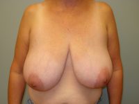 Breast Reduction