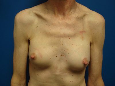 Breast Reconstruction