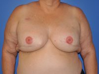 Breast Reconstruction Before & After Photos