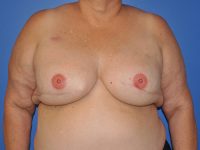 Breast Reconstruction