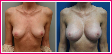 Breast Augmentation Surgery Results Austin