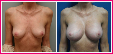 Breast Augmentation Before and After