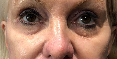 Tear Trough Filler Before Photo of woman's eyes