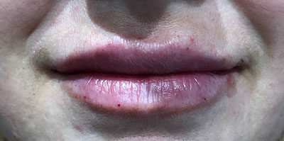 Lip Filler