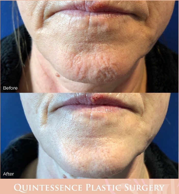 Botox® Before & After Results
