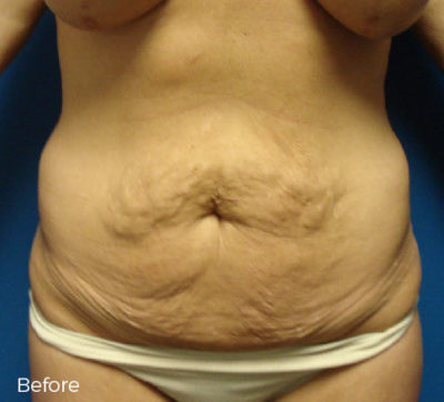 Abdominoplasty