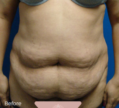 Abdominoplasty