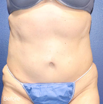 Abdominoplasty