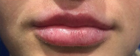 Lip Filler After