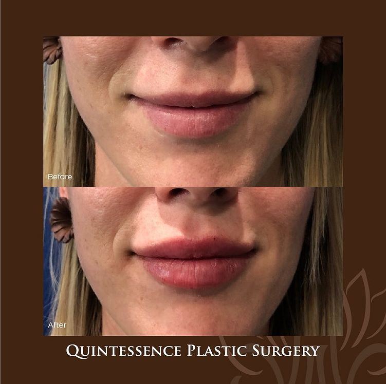 Would you even know this q-tie had lip filler if you weren’t looking at the before photo? We’re loving how natural these results are.