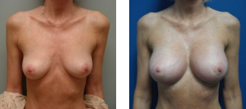 Natural Breast Augmentation Before and After